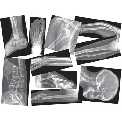 Roylco Inc Broken Bones X-rays Educational Tool