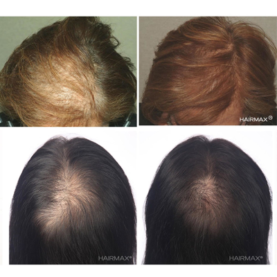 Hairmax Laserband 82 Comfortflex Hair Growth Device In Default Title