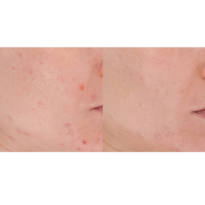 Lightstim For Acne In Default Title