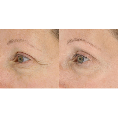 Lightstim For Wrinkles In Default Title