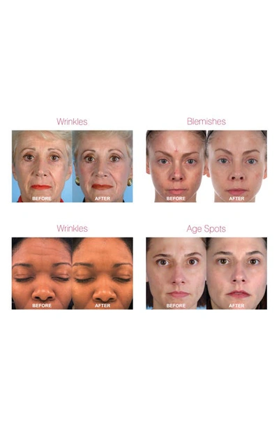 Pmd Personal Microderm Pro Device-$219 Value In White