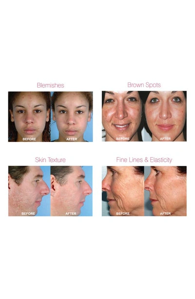 Pmd Personal Microderm Pro Device-$219 Value In White