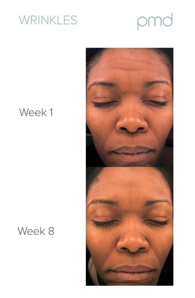 Pmd Personal Microderm Pro Device-$219 Value In White