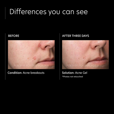 Pca Skin Acne Gel With Omnisome In Default Title