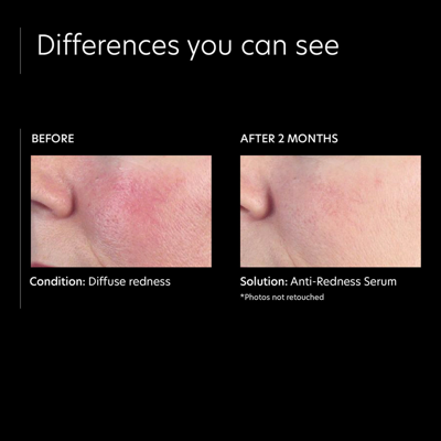 Pca Skin Anti-redness Serum In Default Title