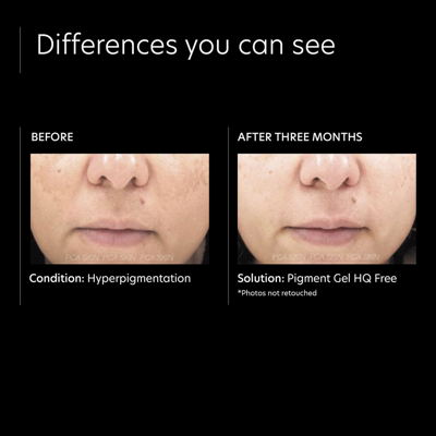 Pca Skin Pigment Gel Hq Free In Default Title