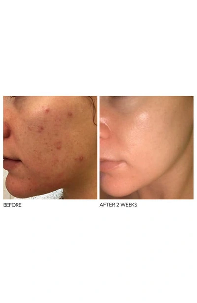 Dr Dennis Gross Skincare Alpha Beta Extra Strength Daily Peel 5 Days - One Size