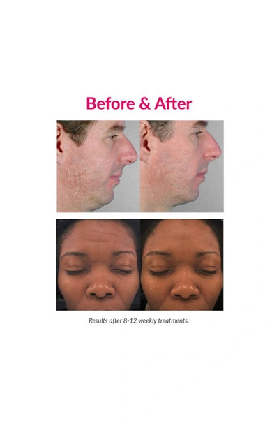 Pmd Classic Personal Microderm Device In Berry