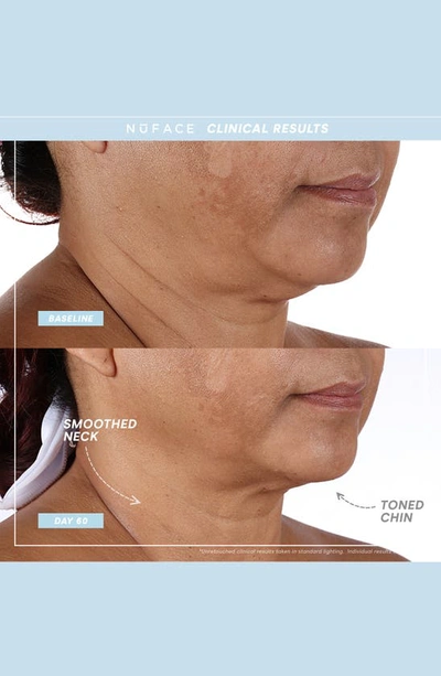 Nuface ® Trinity+ Smart Advanced Facial Toning Device Starter Kit