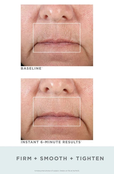 Nuface Fix Line Smoothing Device