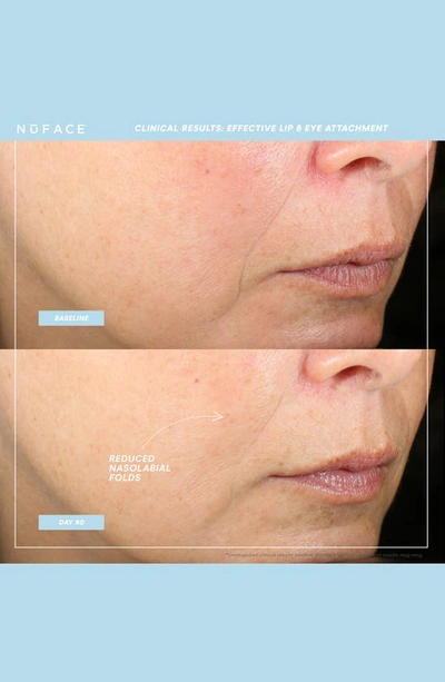 Nuface Trinity+® Effective Lip & Eye Attachment