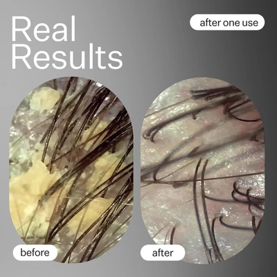 Act+acre Scalp Relief System In Default Title