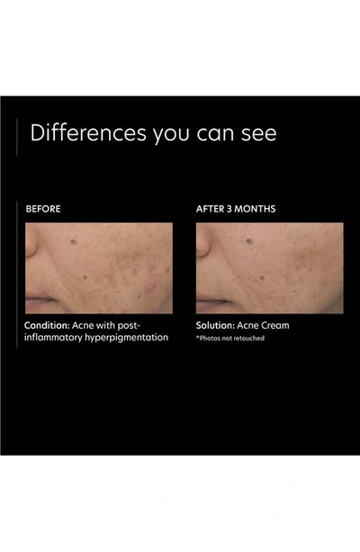 Shop Pca Skin Acne Cream Spot Treatment