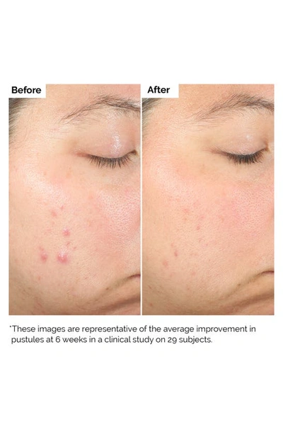 The Ordinary Salicylic Acid 2% Exfoliating Blemish Solution 1 oz / 30 ml 1 oz / 30 ml