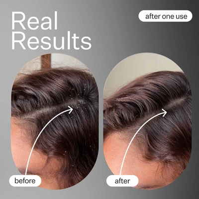 Act+acre Cold Processed Scalp Renew 35ml In Default Title