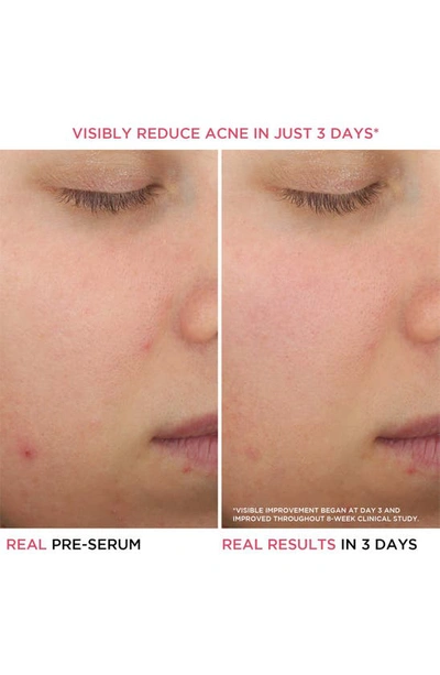 It Cosmetics Bye Bye Breakout Salicylic Acid Acne Serum