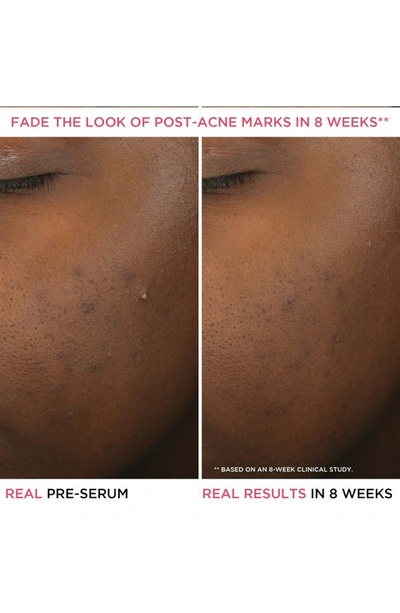 It Cosmetics Bye Bye Breakout Salicylic Acid Acne Serum