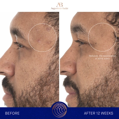 Augustinus Bader The Retinol Serum 30 ml In Default Title