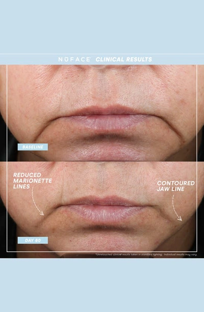 Nuface Trinity+ Complete Advanced Facing Toning Kit