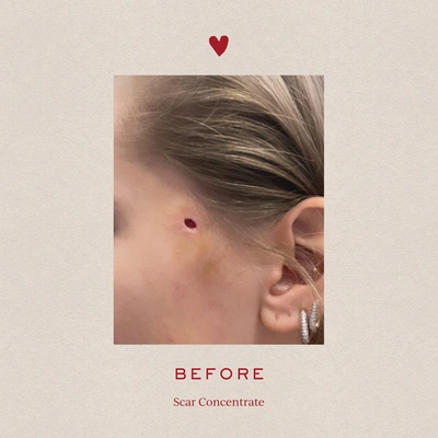 Tronque Scar Concentrate In Default Title