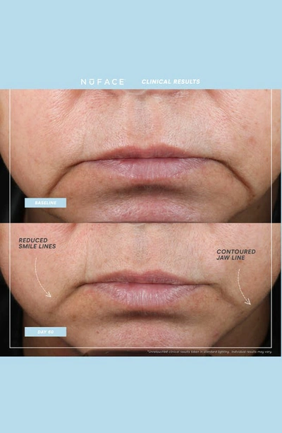 Nuface ® Trinity+ Smart Advanced Facial Toning Device System $395 Value
