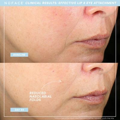 Nuface Trinity+ Effective Lip & Eye Attachment - One Size In Default Title