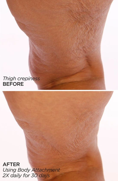 Beautybio Glopro® Body Microtip™ Attachment Replacement Head