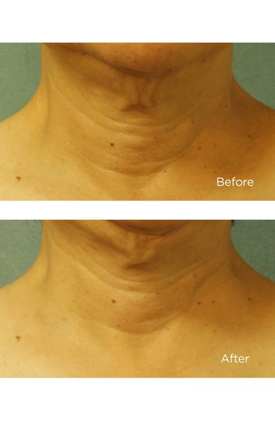Perricone Md Cold Plasma+ Neck & Chest Cream Broad Spectrum Spf 25