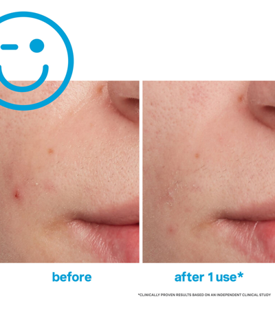 Kate Somerville Eradikate Acne Treatment, 1 Oz. In No Color