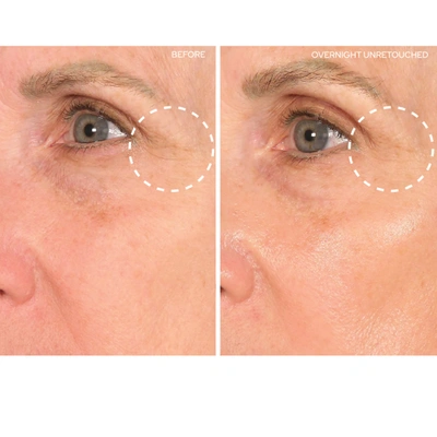 Sio Eye And Smile Lift In 2 Treatments