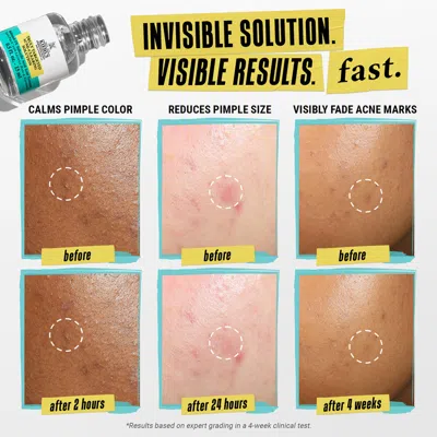 Kiehl's Since 1851 Truly Targeted Acne Clearing Solution With Salicylic Acid 0.5 Oz. In Default Title