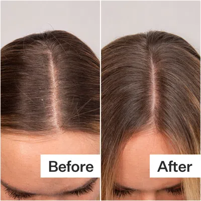 Act+acre Daily Hydro Scalp Serum With Hyaluronic Acid For Dry Scalp
