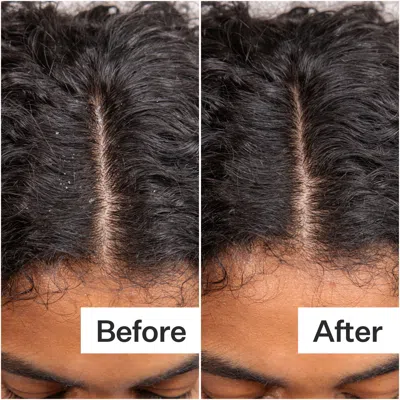 Act+acre Daily Hydro Scalp Serum With Hyaluronic Acid For Dry Scalp