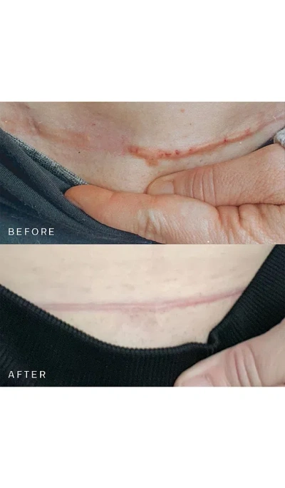 Dermaclara Scar Occlusion Patch