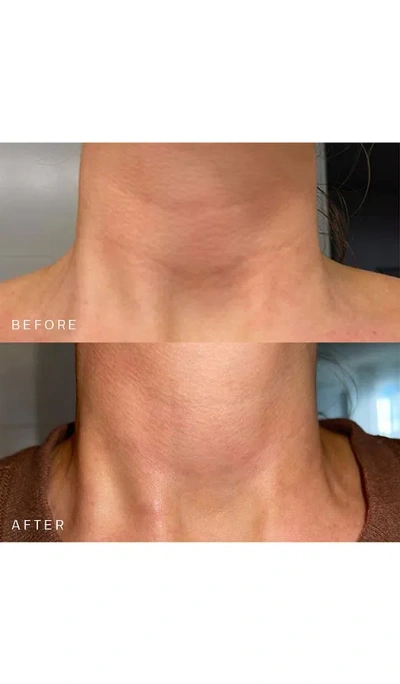 Dermaclara Neck Occlusion Patch