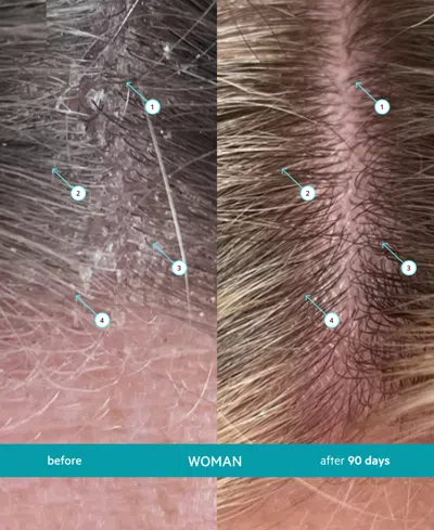 Ds Laboratories Dandrene Exfoliating Anti-dandruff Shampoo, 205 ml