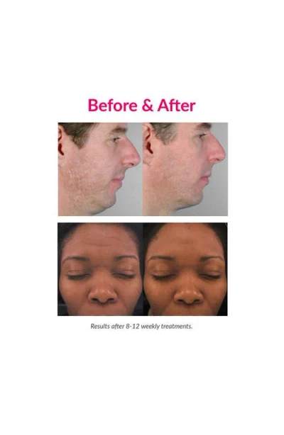 Pmd Personal Microderm Elite Pro Exfoliation Device