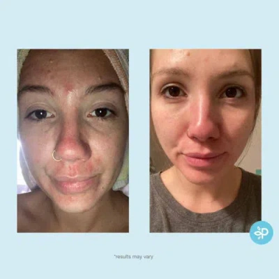 Perfect Image Glycolic 30% Gel Peel