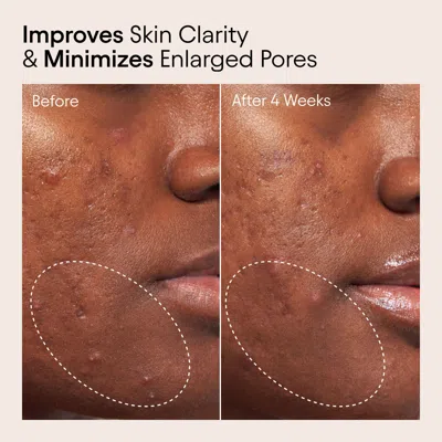 Bluemercury 2% Bha Pore Perfecting Liquid Exfoliator For Brighter And Clearer Skin