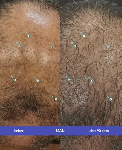 Ds Laboratories Spectral.uhp Men's Extra Strength Regrowth Treatment With Minoxidil 5%, 3-month Supply In Transparent