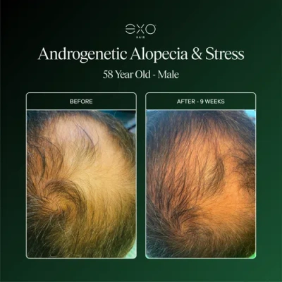 Exoceuticals Exo Fortify Revitalizing Hair & Scalp Treatment In Black