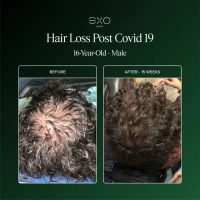 Exoceuticals Exo Activate Follicle Enrichment Serum In Black