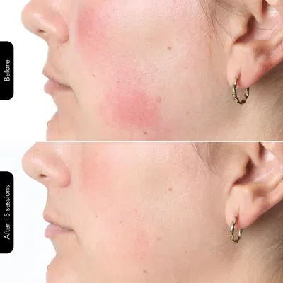Silk'n Led Face Mask And Neck Mask Bundle