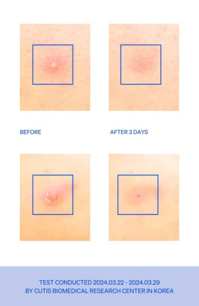 Knemo Right Away Microtip Spot Patches In Blue
